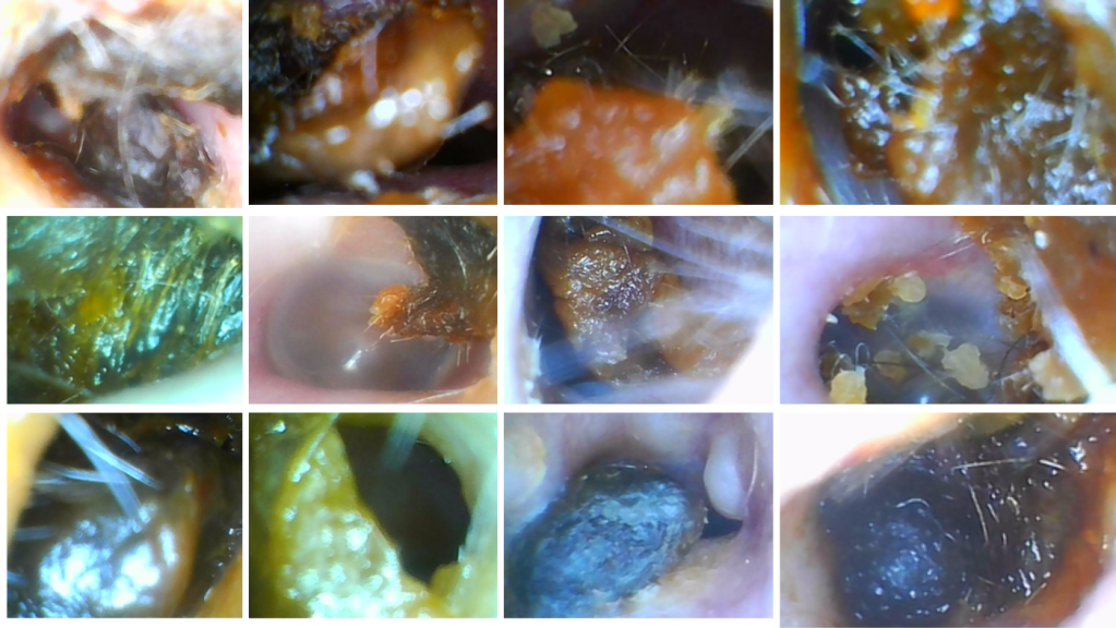 Ear Wax Colour: What It Means and When to Worry - Suction Ears